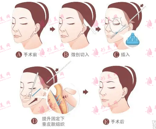 　　上海九院拉皮价格表