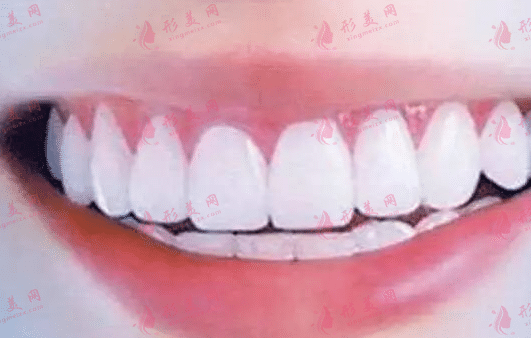 冷光牙齿美白