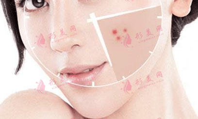 红蓝光祛痘的适应人群及禁忌人群|能彻底治好痘痘吗？