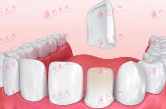 超薄瓷贴面后悔了怎么办？术后有哪些注意事项？