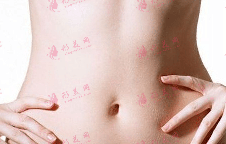 腰腹吸脂