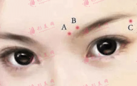 提眉术的适应范围|提眉术后可以敷冰袋吗？