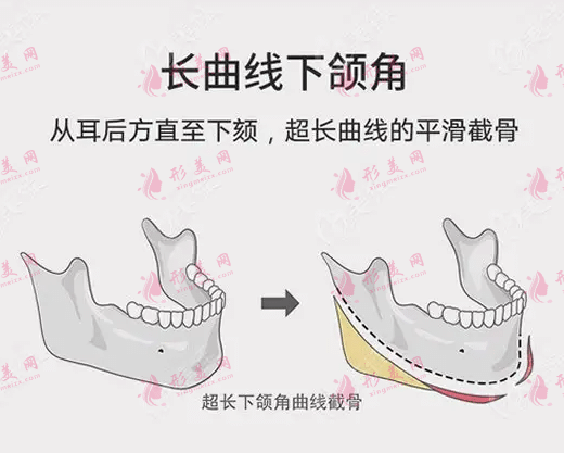 下颌角整形是怎样操作?