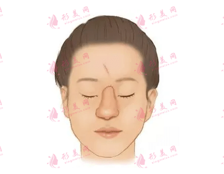 鼻再造