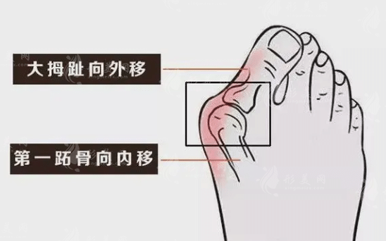 北京做大脚骨选择哪位医生好?苏敬达、马桂文、陈圣英等专家