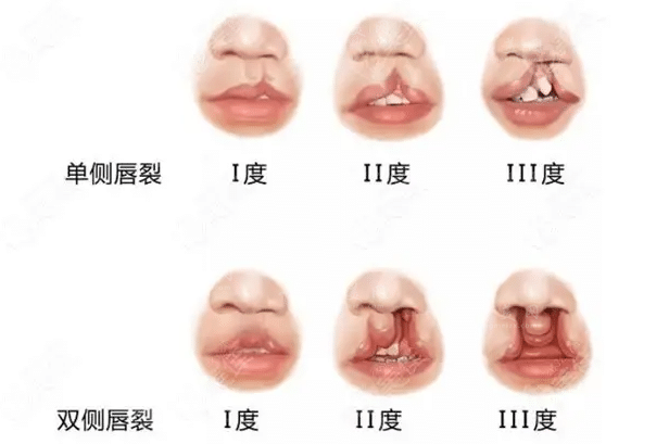 全国唇腭裂修复好的医院排名分享｜这几家口碑实力都不错