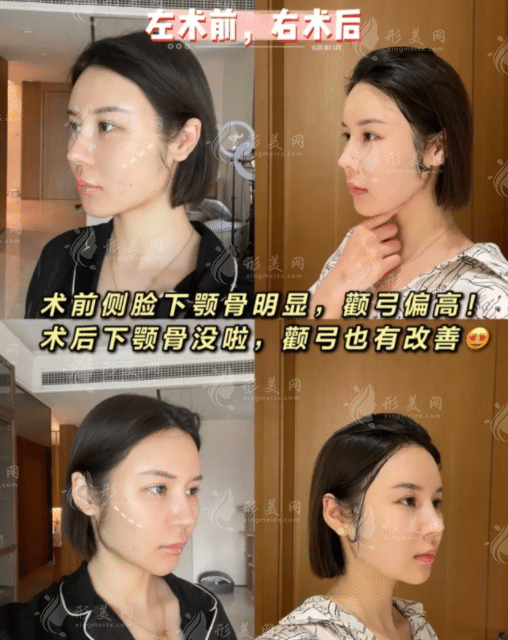 武汉亚韩赵贵庆磨骨怎样？下颌角术后效果变化大吗？