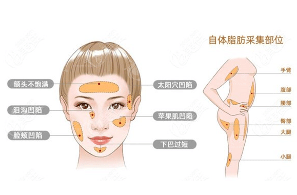 脂肪填充