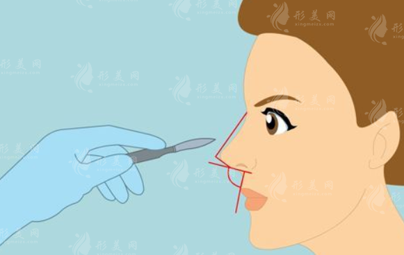 上海华东医院隆鼻怎么样？医生团队介绍+案例分享+价格表