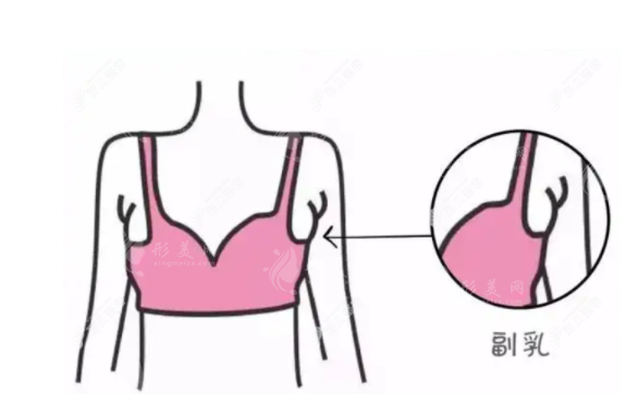 副乳切除是选择微创还是开刀？