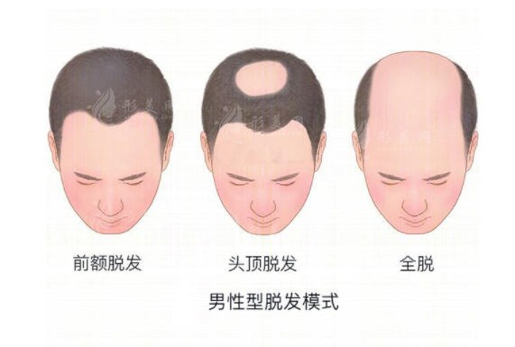 上海第九人民医院植发挂什么科？多少钱？附吴巍医生介绍