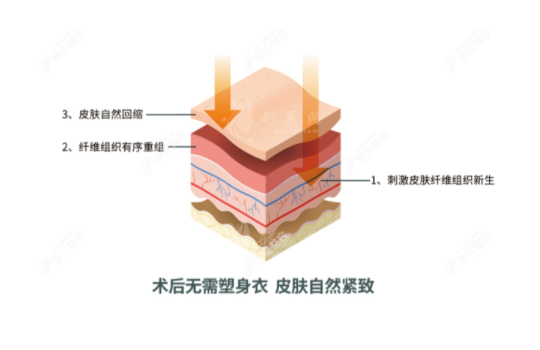 曹孟君治疗富贵包怎么样？土麦森吸脂技术可从根本解决问题