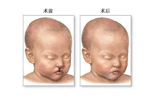 上海第九整形美容医院唇腭裂修复价格