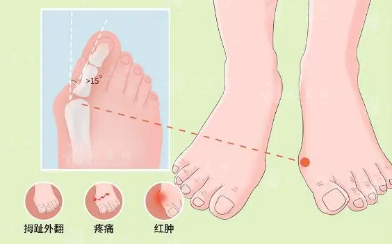 拇外翻手术