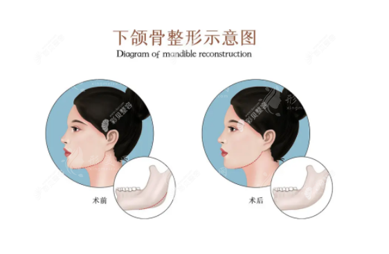 成都磨骨手术专家盘点：拥有四级手术资质的精英医生