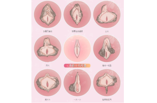 广州曙光整形医院做私密手术好吗？郝卫洁|张小芸技术有保障