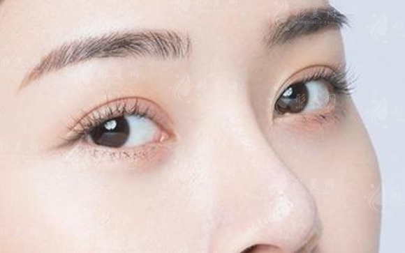 开眼角术后疤痕的修复之路