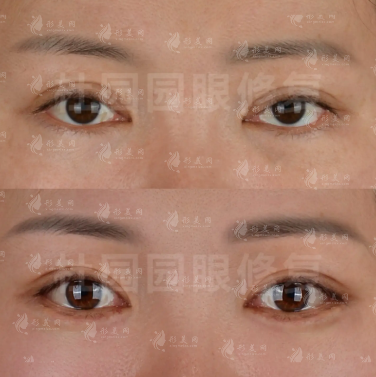 杜园园双眼皮修复