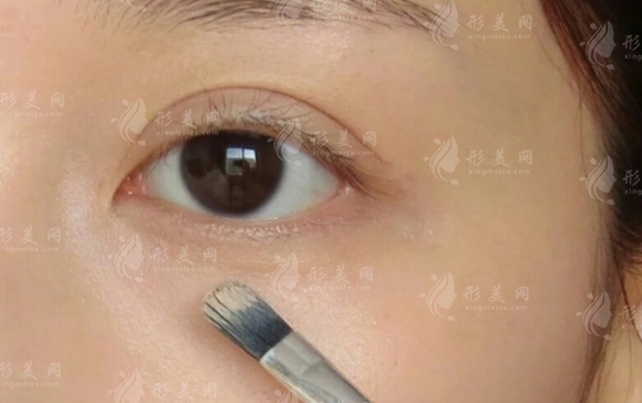 玻尿酸填泪沟好在哪里？原来不选择自体脂肪是这个原因！