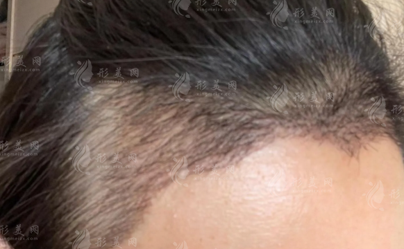 武汉仁爱医院植发靠谱不?技术+价格一文看懂
