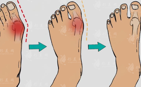 苏敬达医生拇指外翻手术价格揭秘：12800元微创当天走路