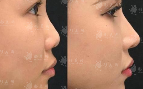 广州隆鼻医生前十名公布，做鼻子就选他们