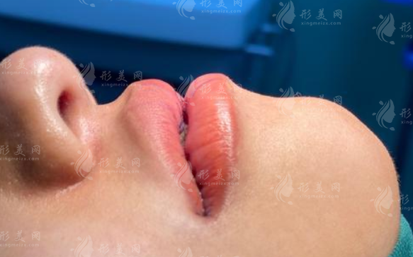 大连厚唇改薄医院哪家好?2025年TOP5对比+避坑指南 大连厚唇改薄医院哪家好?2025年TOP5对比+避坑指南