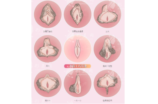 小阴唇整形选哪种形状好？蝴蝶型水滴型柳叶型效果对比