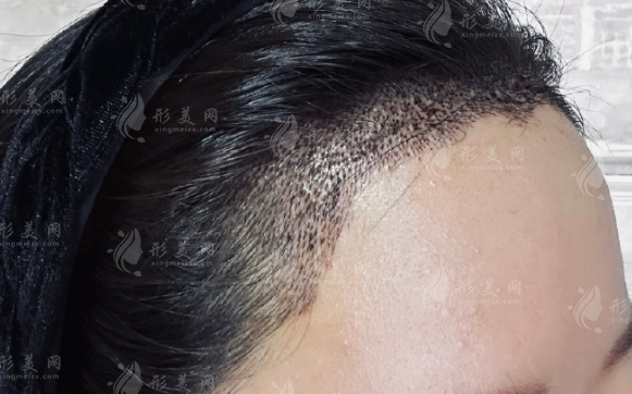 宁夏植发医院排名!银川5家正规植发机构价格技术大比拼