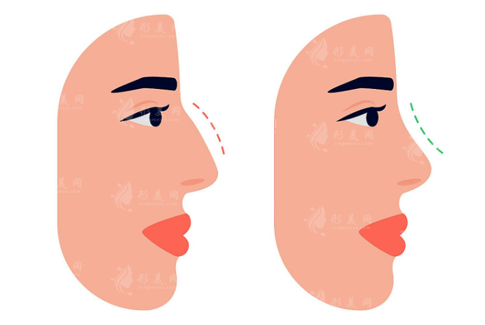 刘彦军鼻整形8万起凭啥？技术实力深扒，看完就懂了