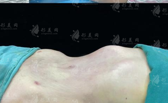 2026深圳吸脂医院哪家强?排名前十技术实力大曝光