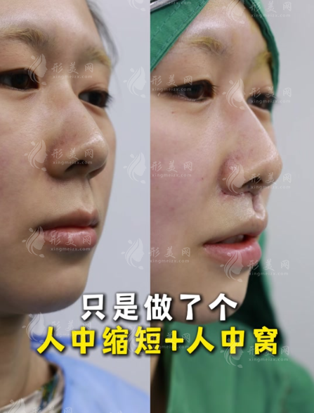 人中缩短术对比照片：明星都在悄悄做的减龄秘诀 