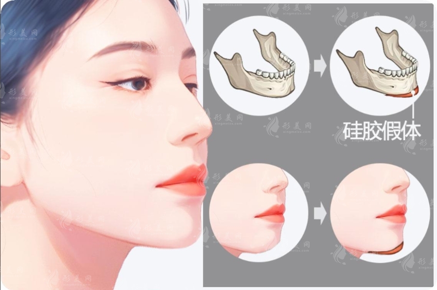 假体下巴后悔率超70%?这些后遗症90%人不知道 假体下巴后悔率超70%?这些后遗症90%人不知道