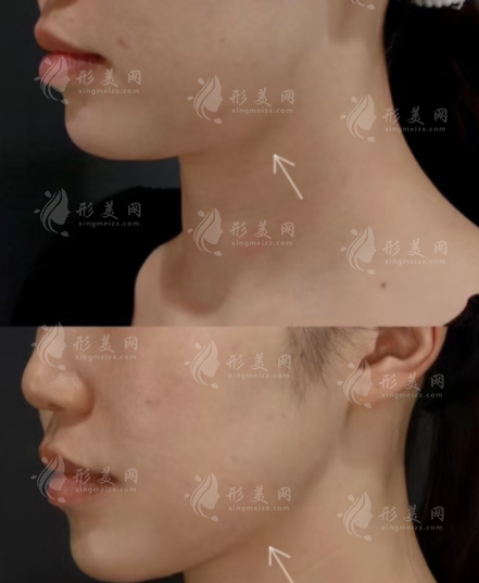 上海时光做下颌角靠谱吗?技术价格医生全解析