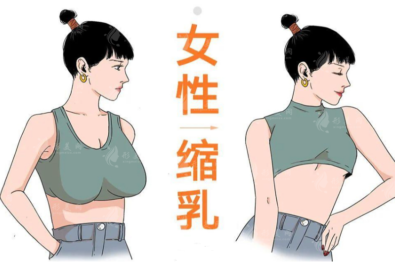 广州缩胸手术价格2026大揭秘：2万到15万差价全解析