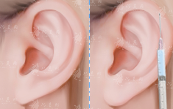 打精灵耳几支玻尿酸才够?6支用量效果全解析