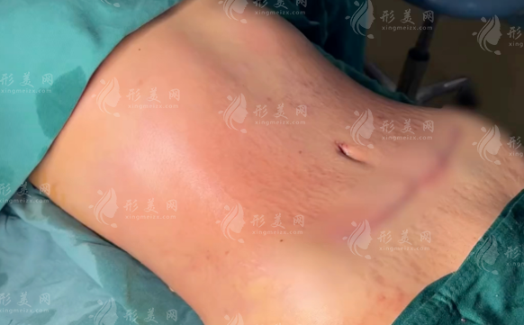 杭州腹壁成型术哪家好?五大医院技术实力全揭秘