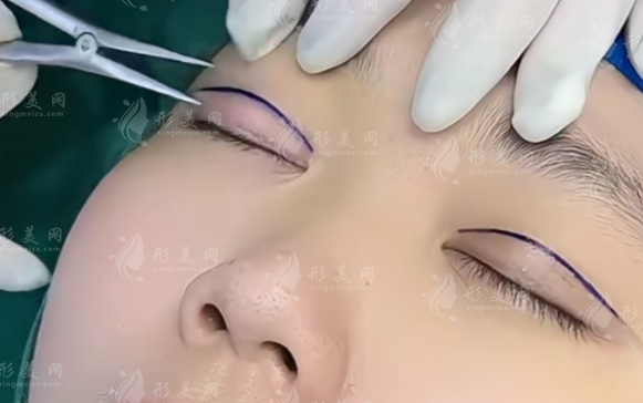 西安双眼皮医生哪家好?这6位专家技术口碑双在线