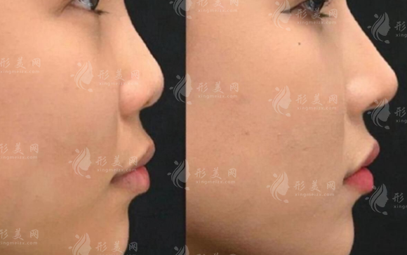 西安鼻整形医生哪家好？2026热门医生+价格全解析