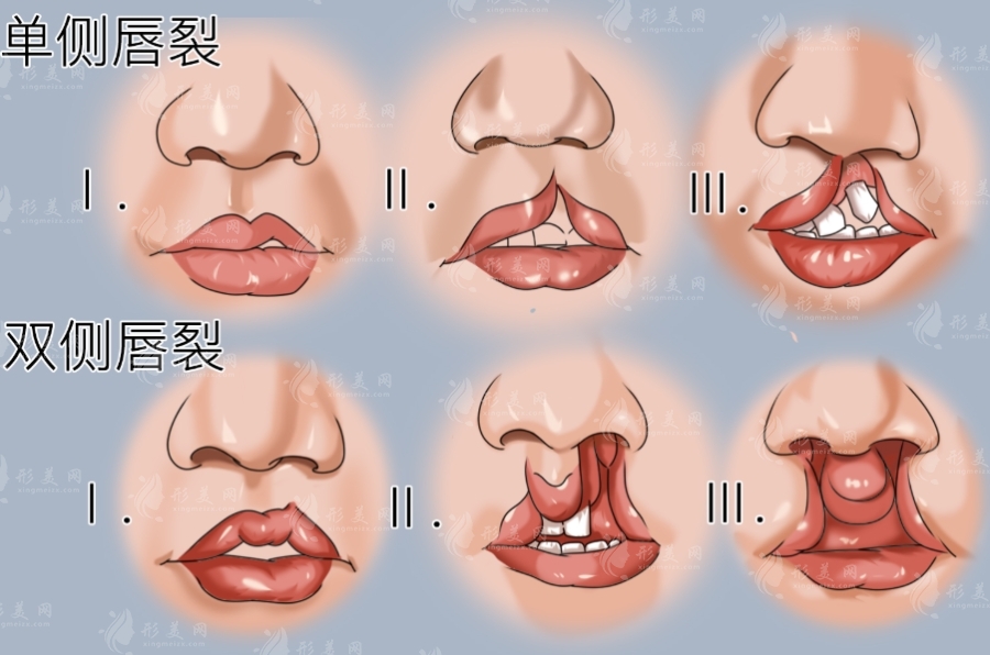 唇裂术后鼻孔不对称怎么办？鼻畸形修复术全攻略