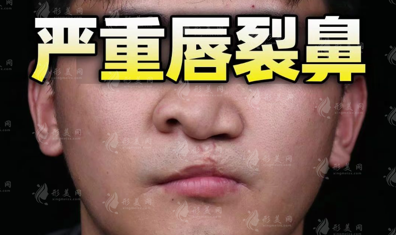 唇裂术后鼻孔不对称怎么办?鼻畸形修复术全攻略 唇裂术后鼻孔不对称怎么办?鼻畸形修复术全攻略