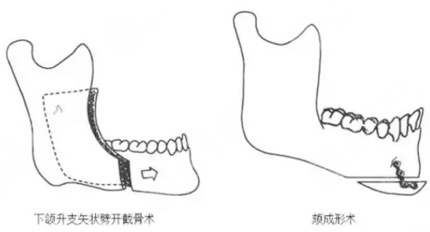 颏成型vs假体垫下巴：7大区别帮你选对不踩坑！