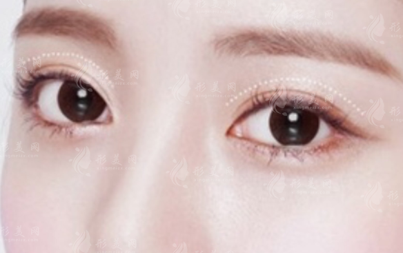 西安眼部整形专家排行!2026眼综合价格表+手术特点