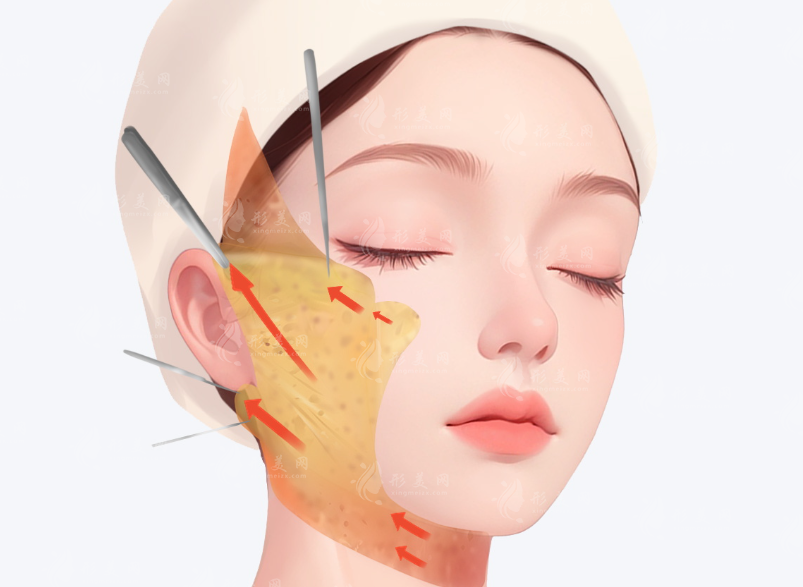 2026北京无痕筋膜提升价格全曝光！多少钱才合理