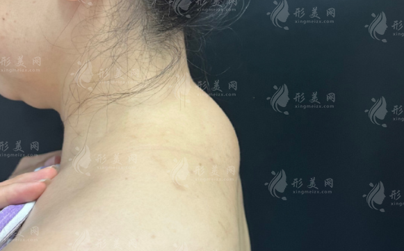 2026国内富贵包消除医院哪家好?吸脂价格表全曝光!