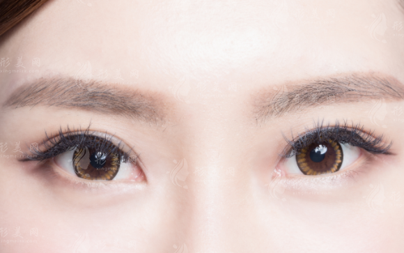 北京晶美魏志香双眼皮修复技术好吗?价格表全解析