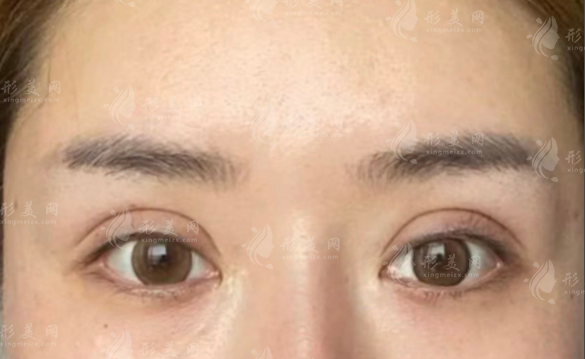 北京双眼皮修复专家排名：6位大咖技术实力全揭秘