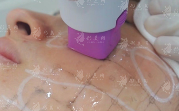 热玛吉5代vs4代怎么选?6大区别避坑指南