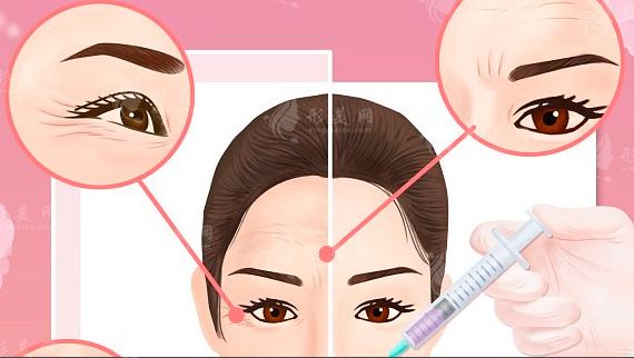 川字纹打玻尿酸还是除皱针？看完这篇不花冤枉钱