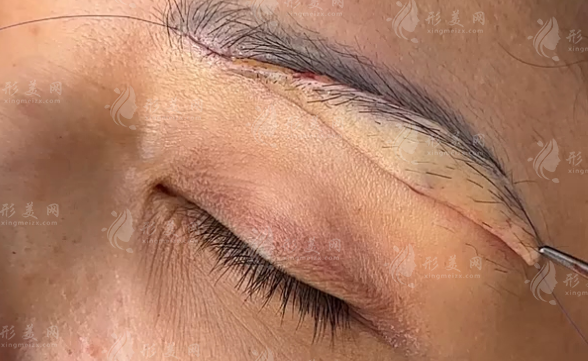 50岁提眉和提眉哪个好?医生教你选对不花冤枉钱